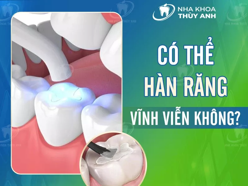 Hàn răng có vĩnh viễn không?